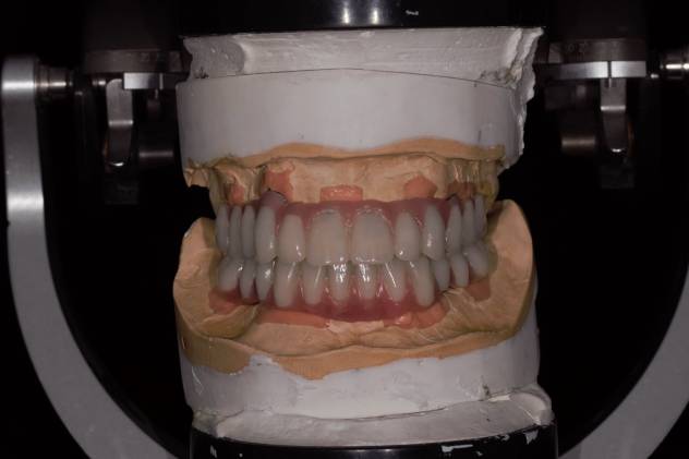 Hybrid Full/Full Implant Bridge