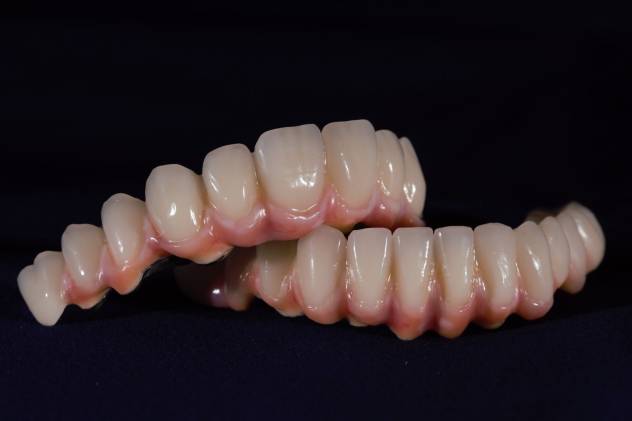 Definitive restorations with composite gum work